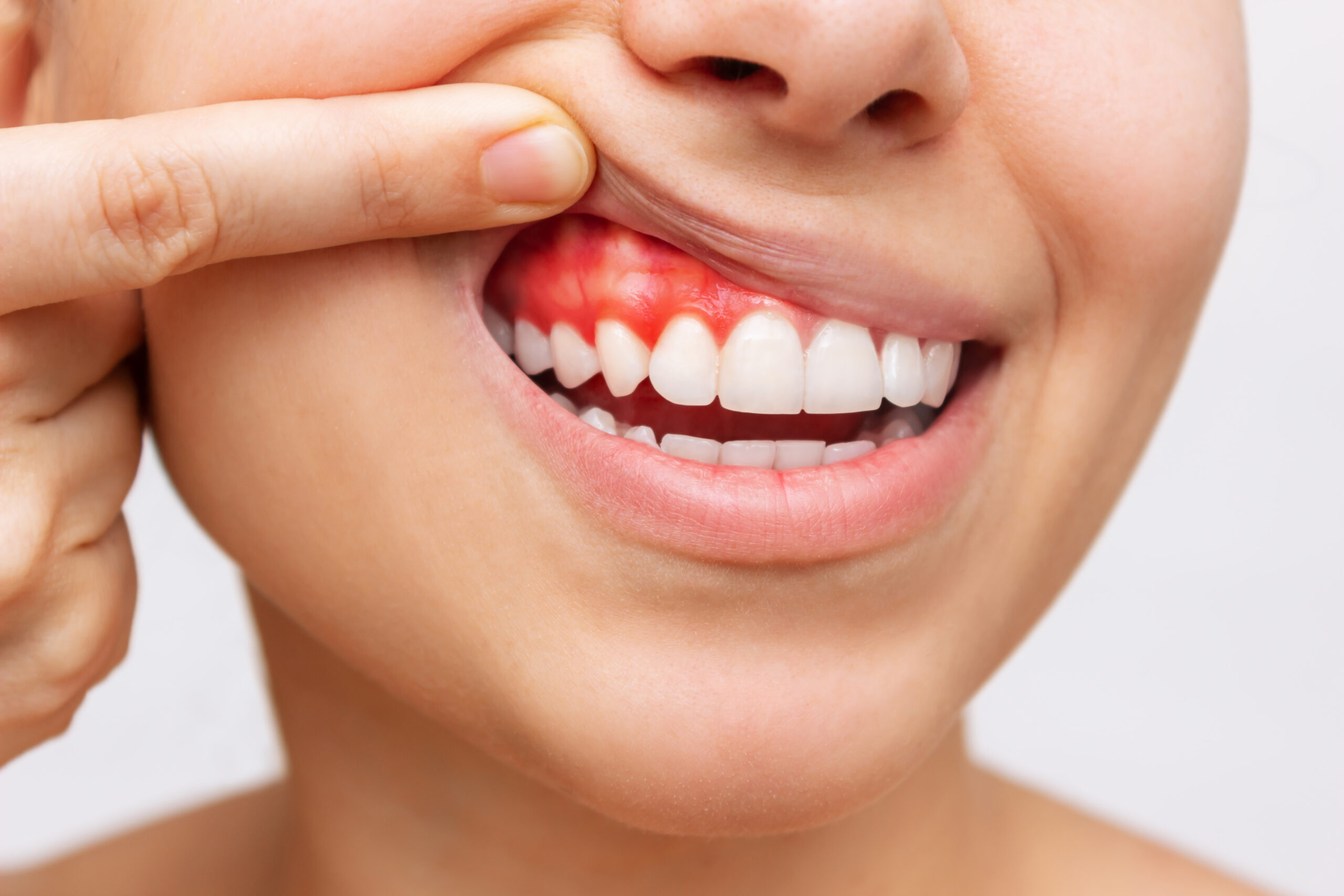 gum-inflammation-cropped-shot-young-woman-showing-bleeding-gums-isolated-white-background gum-inflammation-cropped-shot-young-woman-showing-bleeding-gums-isolated-white-background